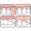 Купить TePe з/нить Bridge and Implant floss для мостов и имплантов